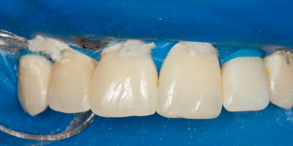  Реставрация зубов 12, 11 по 3 классу и восстановление длины зуба 21
