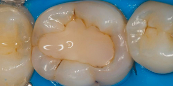 Лечение вторичного кариеса под пломбой, реставрация зуба 46, МОД фото до лечения