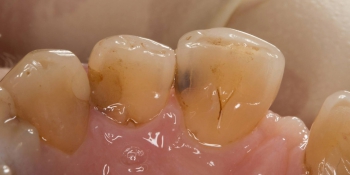 Реставрация зуба 21, дефект по 3 классу фото до лечения