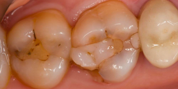 Реставрация жевательных зубов 26 и 27 с армированием фото до лечения