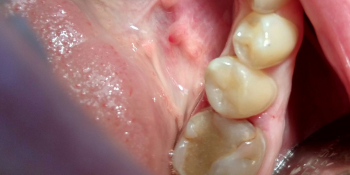 Лечение кариеса депульпрованного  зуба 45 с реставрацией анатомической формы материалом FiltekZ550 фото после лечения