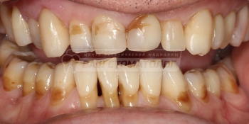 Эстетическая реставрация зубов фото до лечения