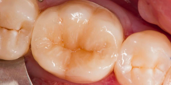 Восстановление зуба после эндодонтического лечения фото после лечения