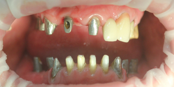 Комплексное восстановление жевательной и эстетической функции зубов фото до лечения