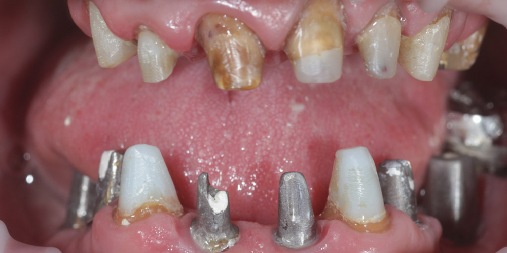  Полная эстетико-функциональная реабилитация зубов