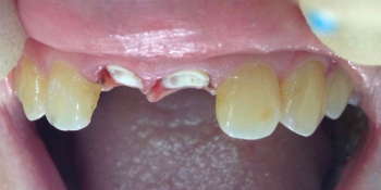 Восстановление центральных резцов верхней челюсти мк коронками фото до лечения