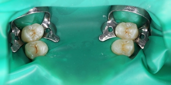 Герметизация фиссур 4 молочных зубов фото до лечения