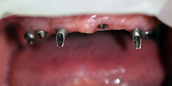 Восстановление жевательной функции при полном отсутствии зубов на верхней и нижней челюсти фото до лечения