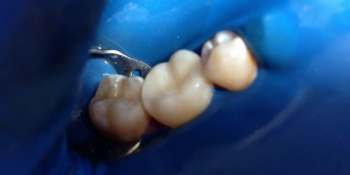 Жалобами на чувствительность зубов с правой стороны на сладкое фото после лечения