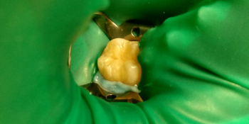 Лечение кариеса на жевательном зубе материалом FiltekZ550 фото после лечения