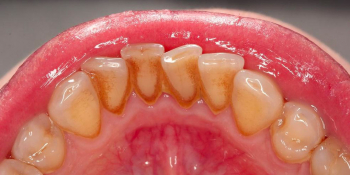 Результат профессиональной гигиены полости рта фото до лечения