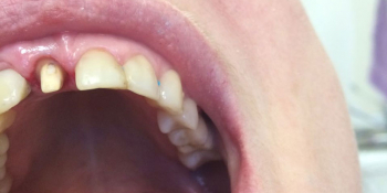 Реставрация фронтальной группы зубов безметалловыми коронками е-Мах фото до лечения