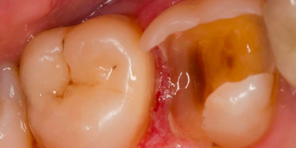  Реставрация жевательных зубов 26 и 27 с армированием