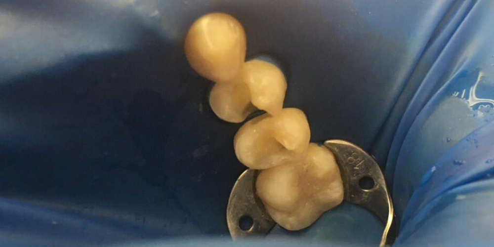  Лечение кариеса двух жевательных зубов