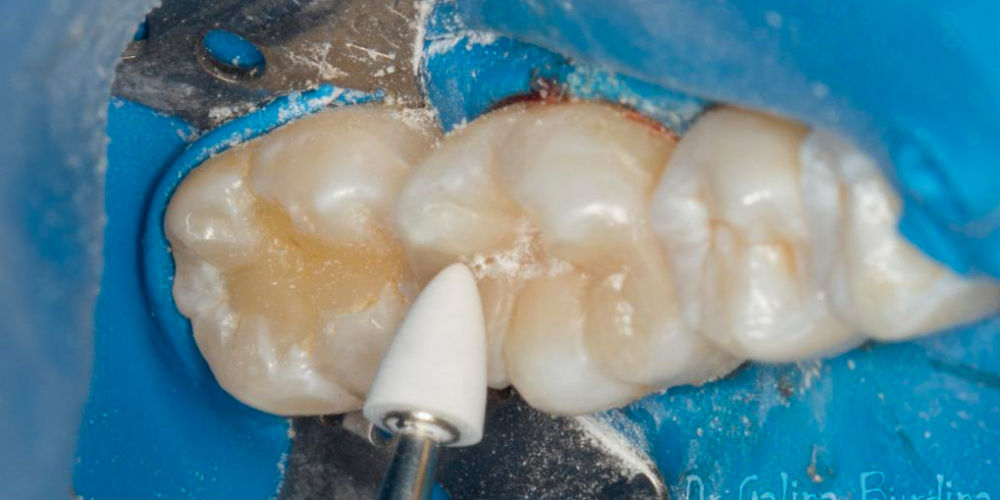 Лечение вторичного кариеса под пломбой, реставрация зуба 46, МОД
