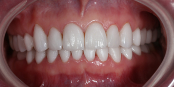 Реконструкция зубов керамическими винирами фото после лечения