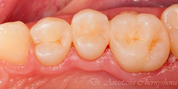 Лечение кариеса трех зубов подряд фото после лечения