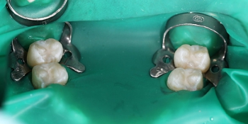 Герметизация фиссур 4 молочных зубов фото после лечения