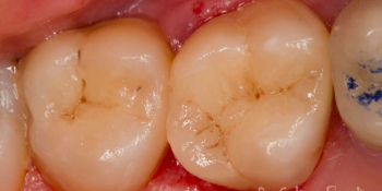 Реставрация жевательных зубов 26 и 27 с армированием фото после лечения