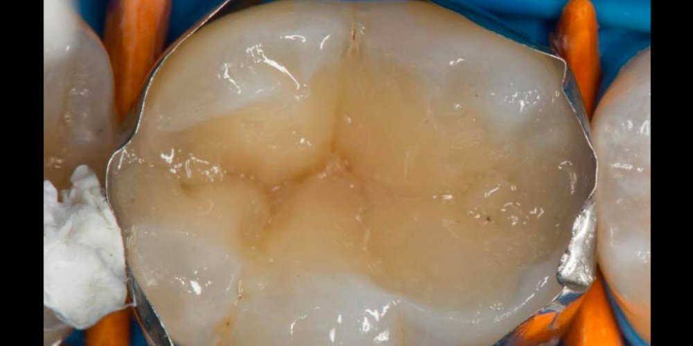  Лечение вторичного кариеса под пломбой, реставрация зуба 46, МОД