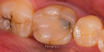 Восстановление зуба после эндодонтического лечения фото до лечения