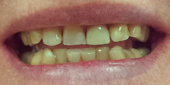 Изготовление и установка керамических виниров E-MAX на передние зубы фото до лечения