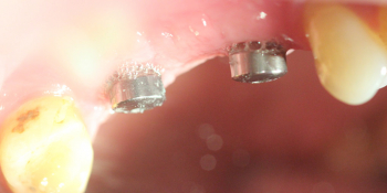 Восстановление двух зубов подряд: имплантация, синус-лифтинг, протезирование фото до лечения