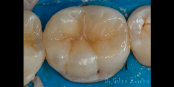 Лечение вторичного кариеса под пломбой, реставрация зуба 46, МОД фото после лечения