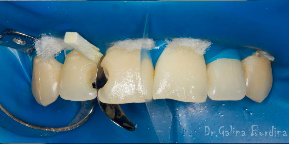  Реставрация зубов 12, 11 по 3 классу и восстановление длины зуба 21