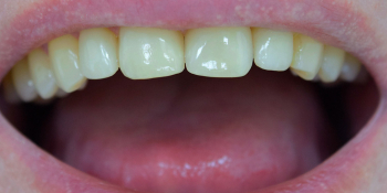 Закрытие диастемы зубов керамическими винирами фото после лечения