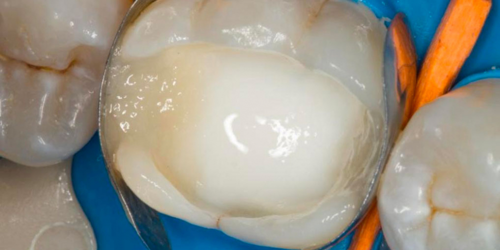  Восстановление зуба после эндодонтического лечения