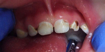 Лечение кариеса и восстановление разрушенных молочных зубов фото до лечения