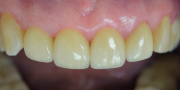 Изготовление и установка керамических виниров E-MAX на передние зубы фото после лечения