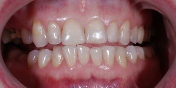 Реконструкция зубов керамическими винирами фото до лечения